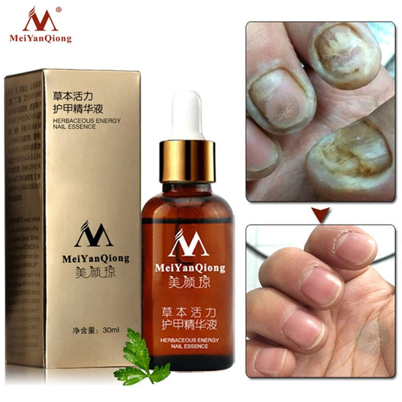 Fungal Nail Treatment Feet Care Essence Nail Foot Whitening Toe Nail Fungus Removal Gel Anti Infection Paronychia Onychomycosis